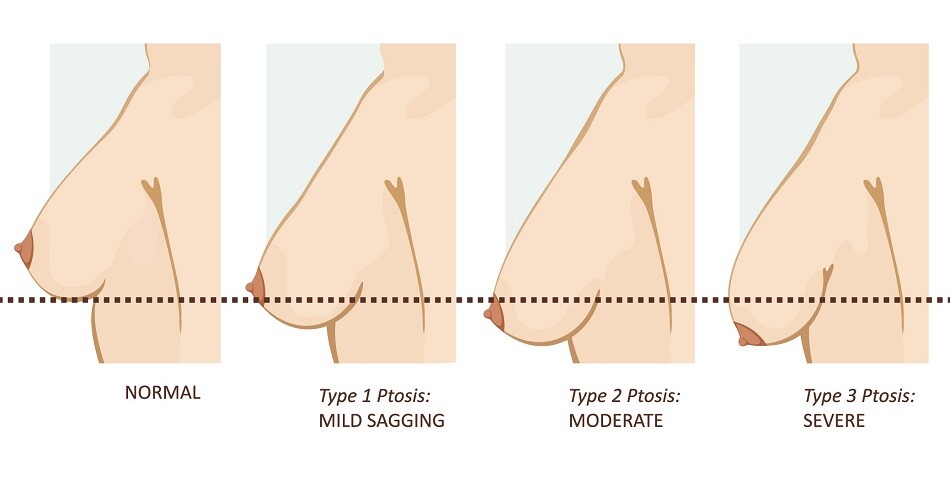 Grading of ptosis for breast lift in Mumbai.
