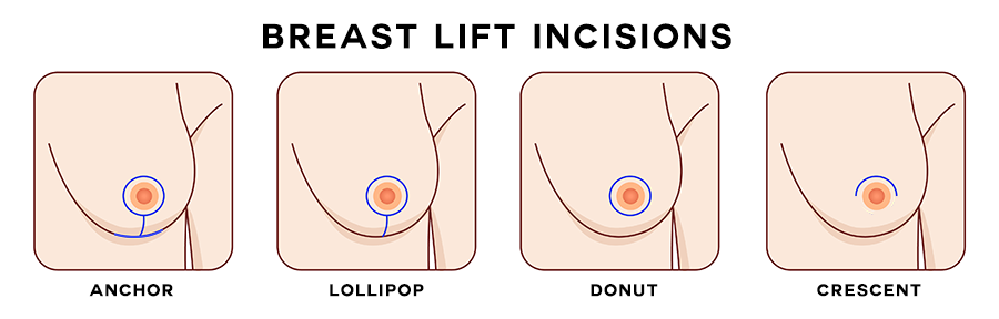 Methods of breast lift in Mumbai.
