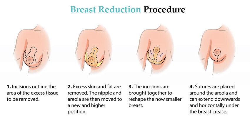Methods of breast reduction surgery in Mumbai.