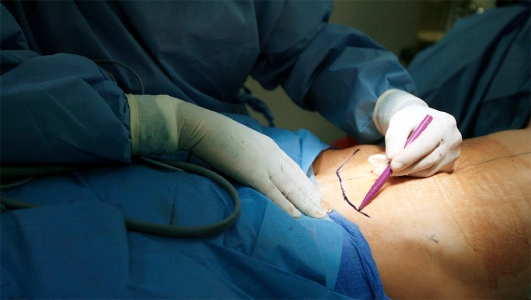 Dr Siddharth Prakash performing Abdominoplasty in Mumbai.